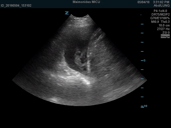 Ultrasound video on a phased array probe shows the swirling movement of the cellular debris, fibrin strands and septations in the pleural cavity.