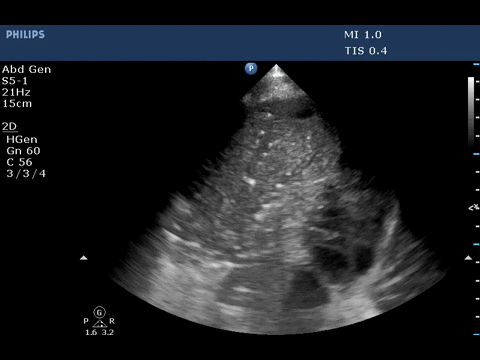Ultrasound
