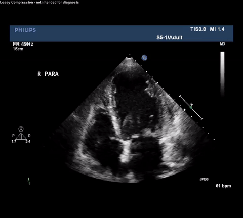 TTE Parasternal Long Axis View