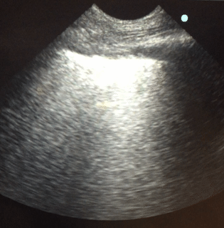 Lung Sonography