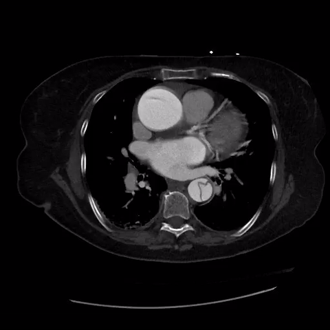 TTE Parasternal Short Axis View