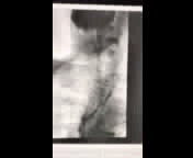 Video 1: Passage of contrast during modified barium swallow study