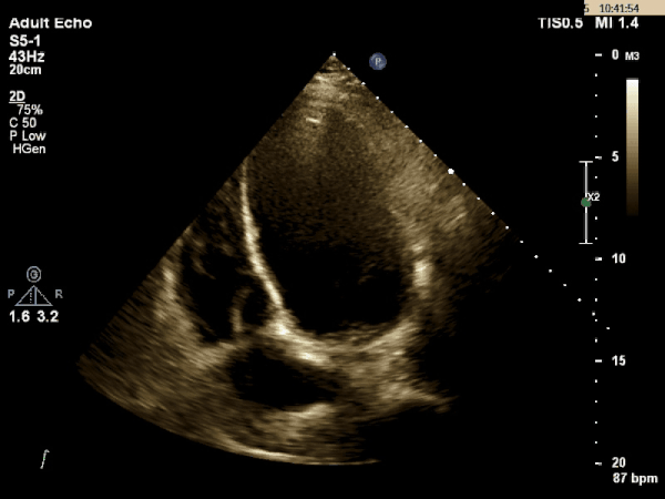 Echocardiogram 2
