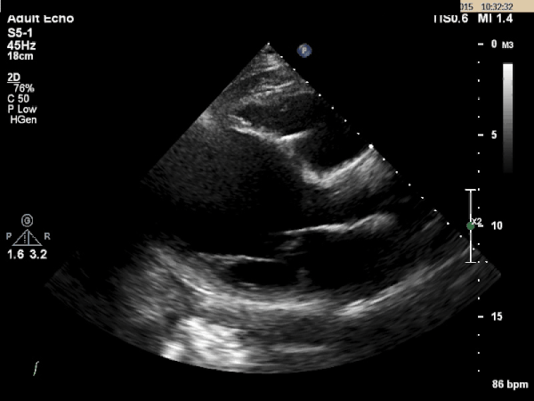 Echocardiogram 2
