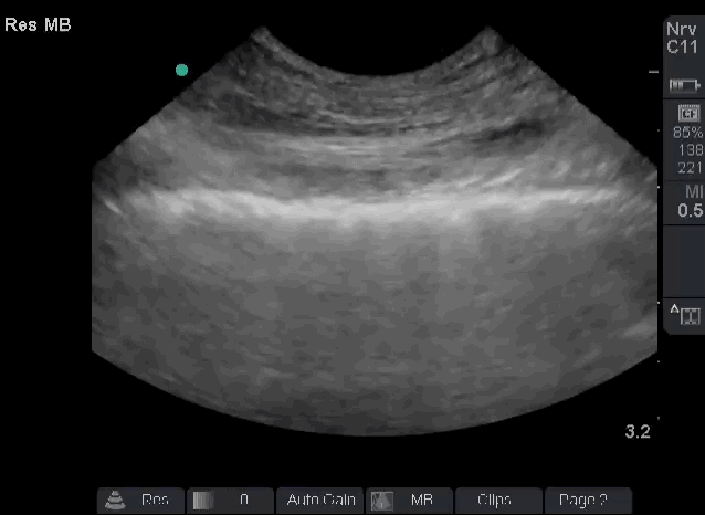 bedside lung sonography