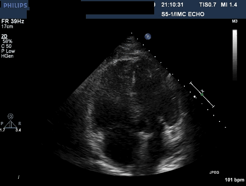 Echocardiogram