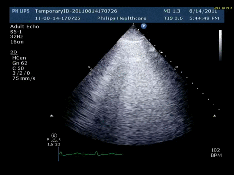 Ultrasound