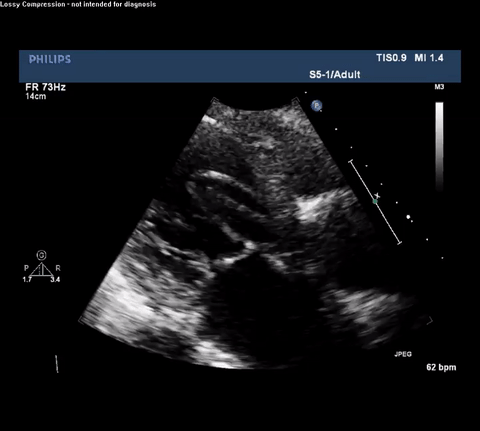 TTE Parasternal Long Axis View