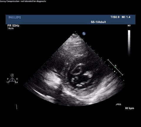 TTE Apical Four Chamber View With Doppler