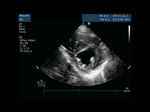 Ultrasound