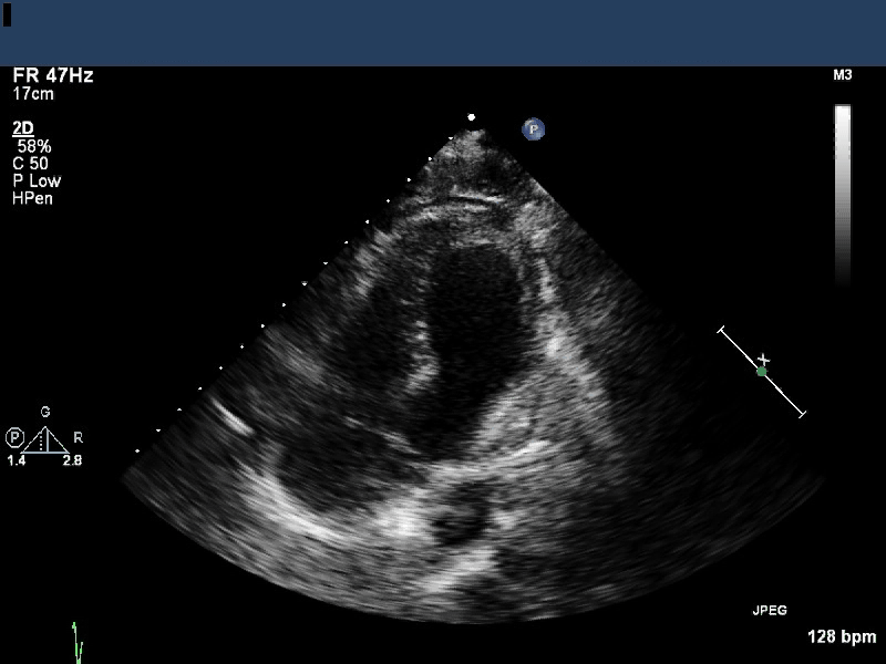 Apical 4 chamber