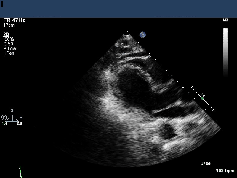Parasternal Long Axis