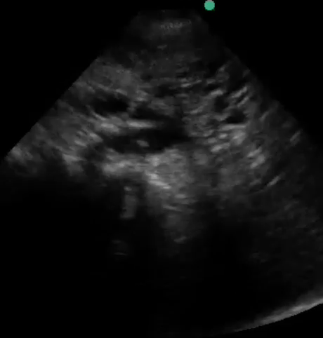 Polycystic Liver Disease