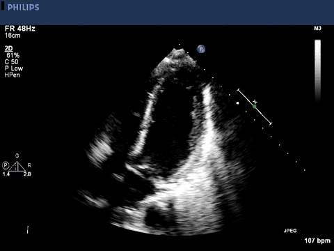 Transthoracic Echocardiogram