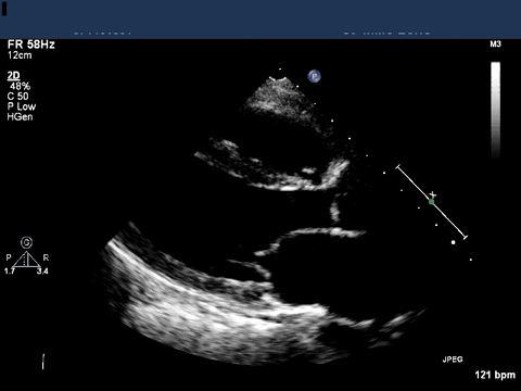 Transthoracic Echocardiogram