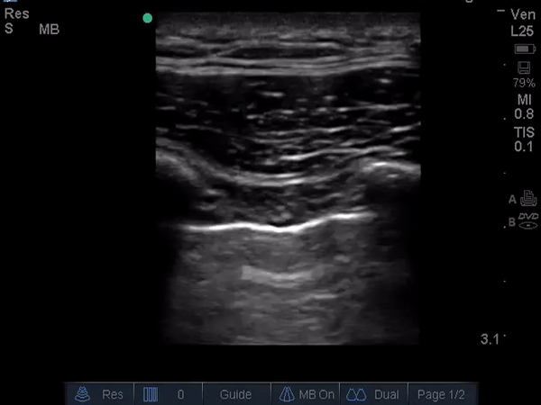 point of care ultrasound right hemithorax