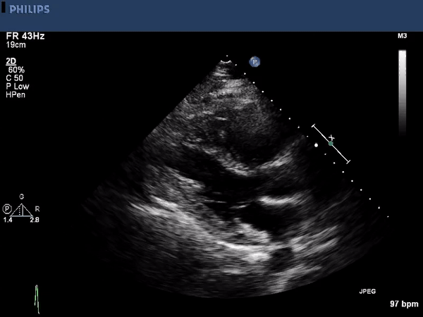 Echocardiogram