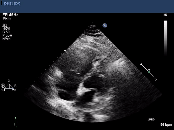 Echocardiogram