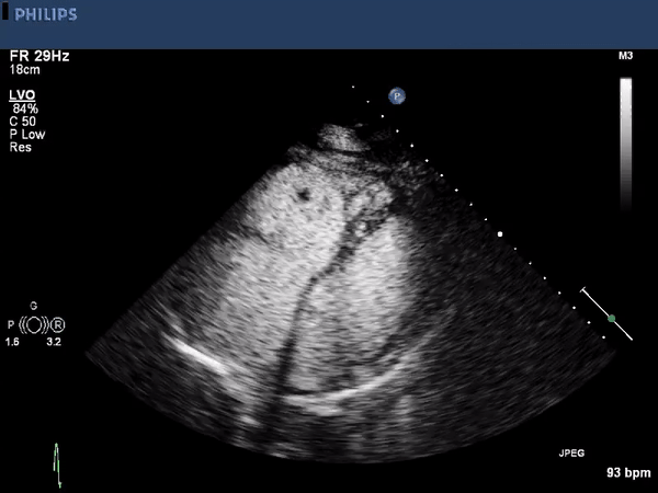 Echocardiogram