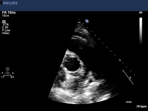 Echocardiogram